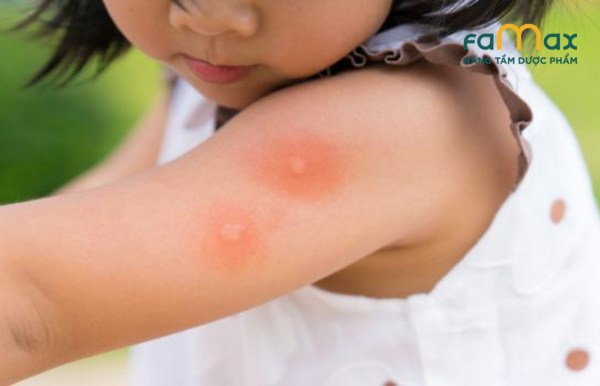 Triệu chứng muỗi đốt ở trẻ