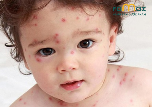 Trẻ bị nổi mẩn đỏ trên mặt là do mụn nhọt