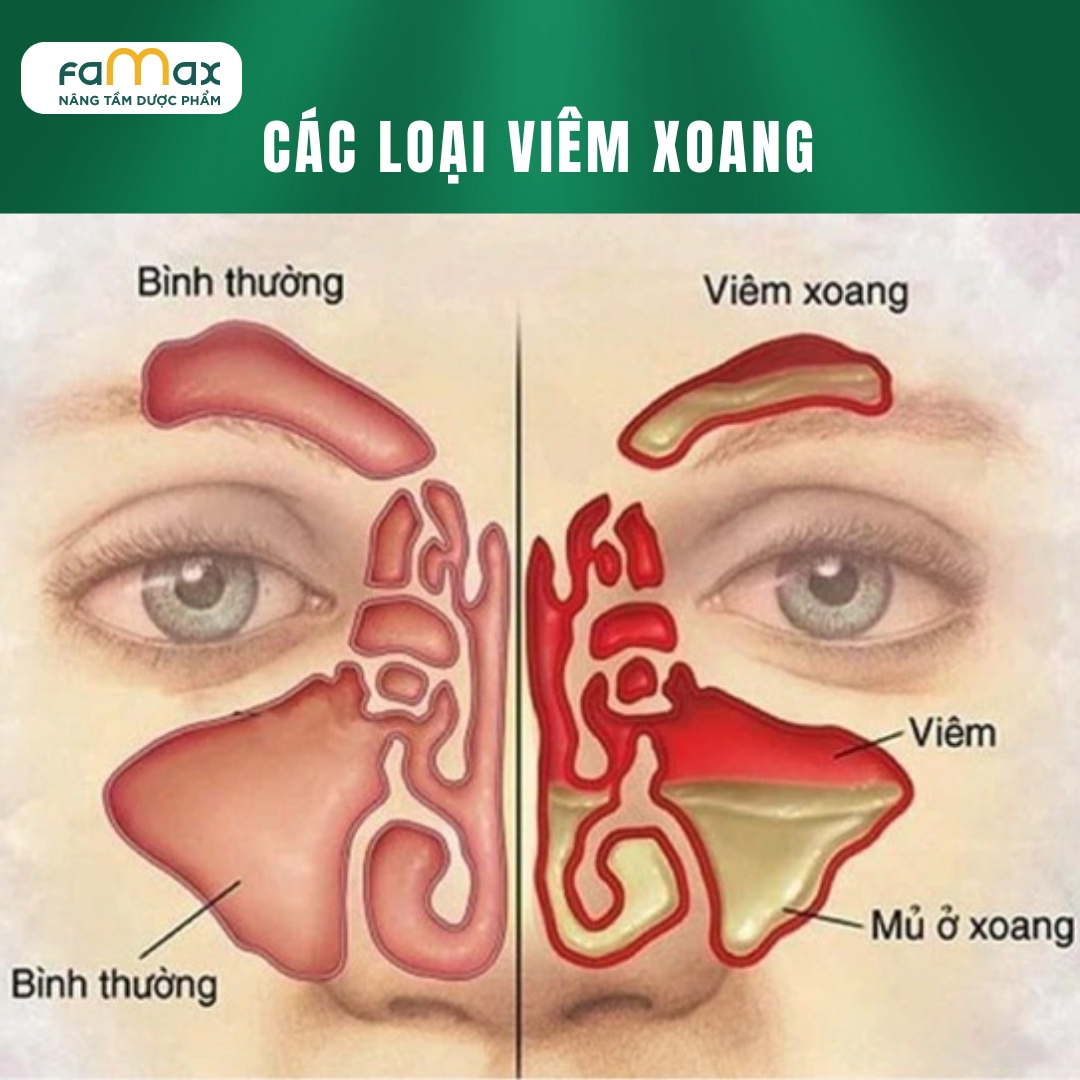 CÁc TriỆu ChỨng ViÊm Xoang