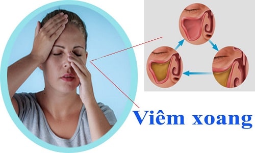 Cách Chữa Viêm Xoang Bằng Tỏi Và Mật Ong Tại Nhà Cực Hiệu Quả Min