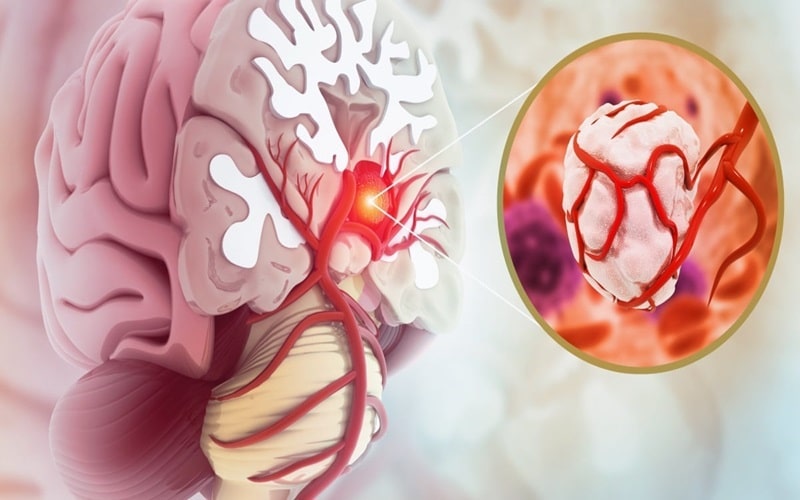 Đau đầu Mệt Mỏi Là Triệu Chứng Của Bệnh Gì