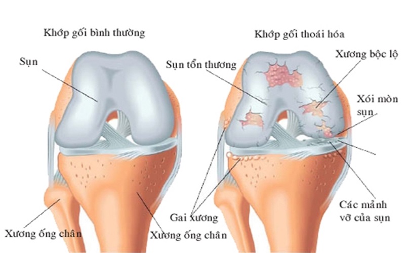 Sụn Khớp Là Gì