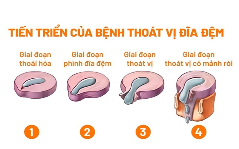 Sụn Khớp Là Gì 2