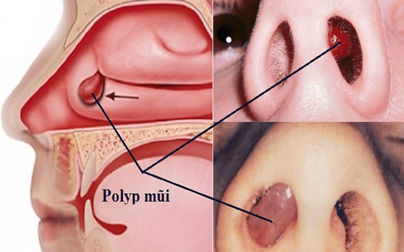 Viêm Xoang Mạn Tính Có Nguy Hiểm Không 1