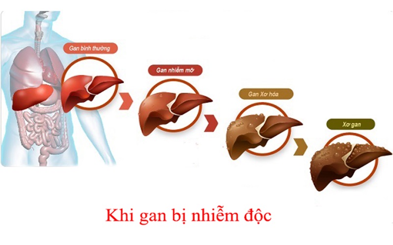 Gan Bi Nhiem Doc
