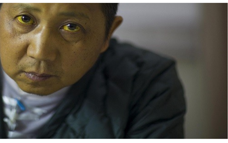 8 Nguyen Nhan Gay Tang Men Gan Va Cach Dieu Tri Tot Nhat 67f9d1cb1aaf1 (1)
