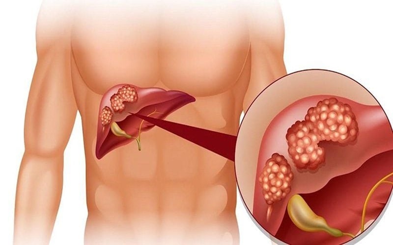 Bệnh Gan Có Lây Qua đường ăn Uống Không 1
