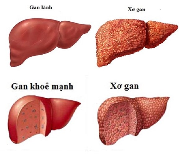 Bệnh Xơ Gan Có ăn được Thịt Gà Không 1