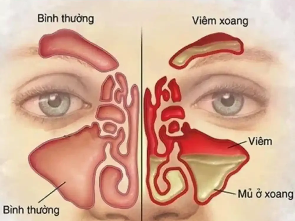 Cac Trieu Chung Viem Xoang