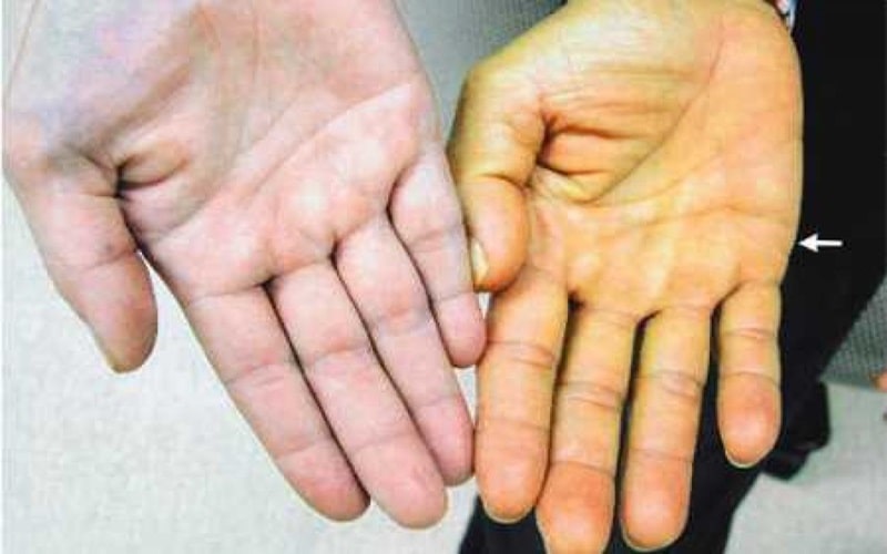 Chi Phí điều Trị Viêm Gan C 1
