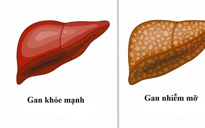 Gan Nhiễm Mỡ Có Hết Không 4