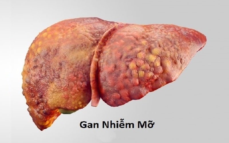 Gan Nhiễm Mỡ Có Hết Không 5