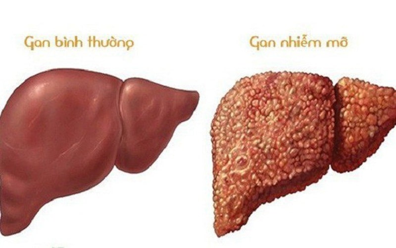 Gan Nhiễm Mỡ Uống Cà Gai Leo được Không