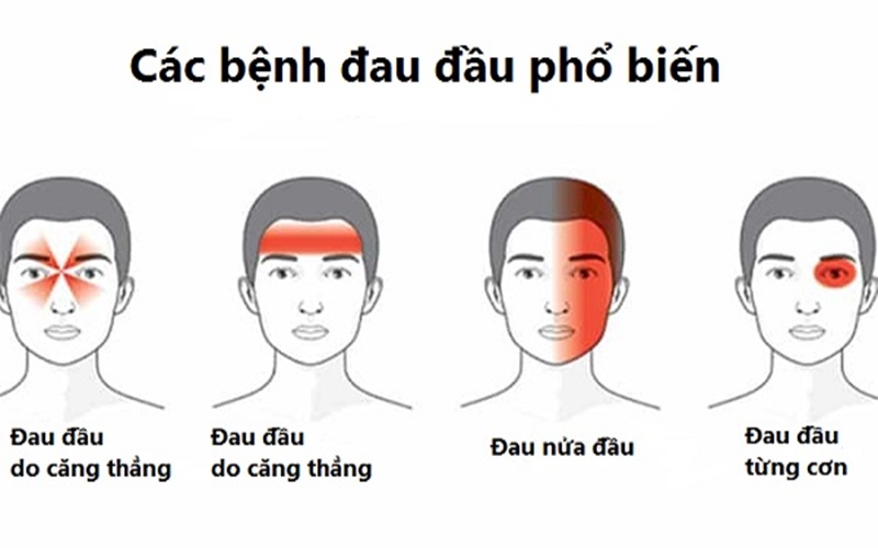 Phân Biệt Bệnh đau Nửa đầu Sau Gáy Bên Phải Với Các Bệnh Khác 2