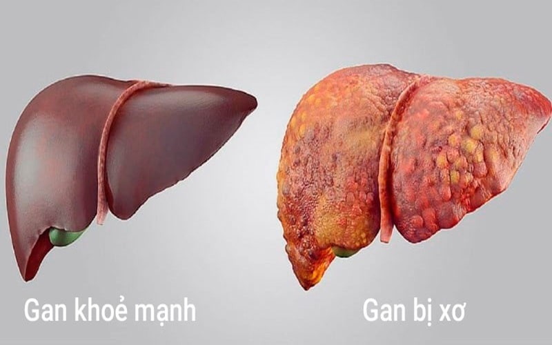 Xơ Gan ứ Mật Nguyên Phát 3