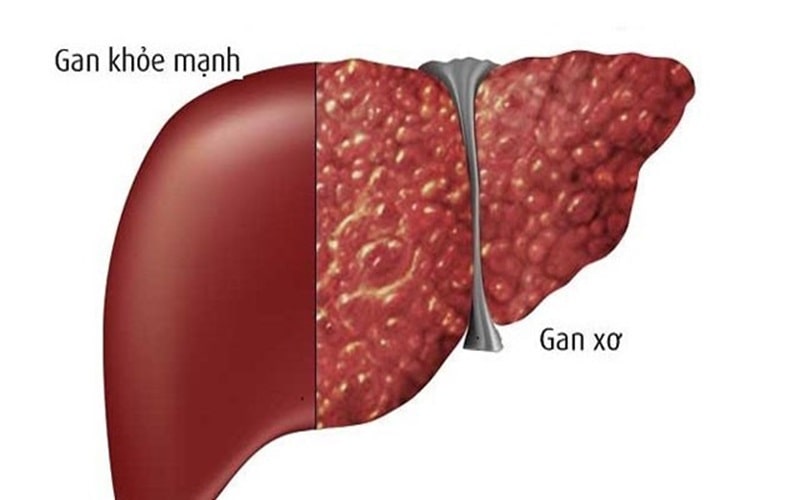 Xơ Gan ứ Mật Nguyên Phát 4