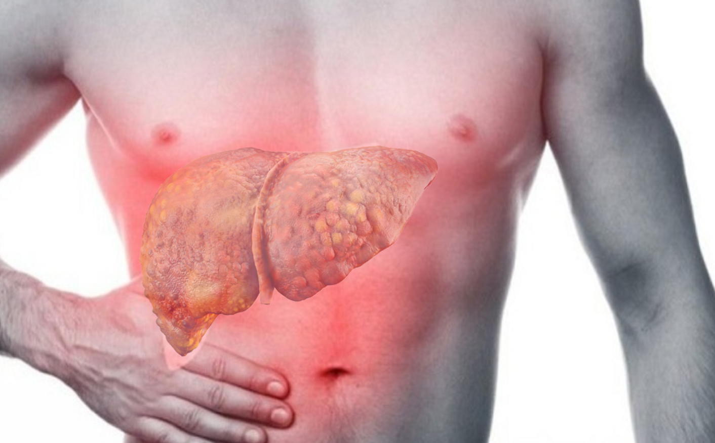 Lách to trong xơ gan - Hiểu rõ nguyên nhân, ảnh hưởng và cách điều trị hiệu quả