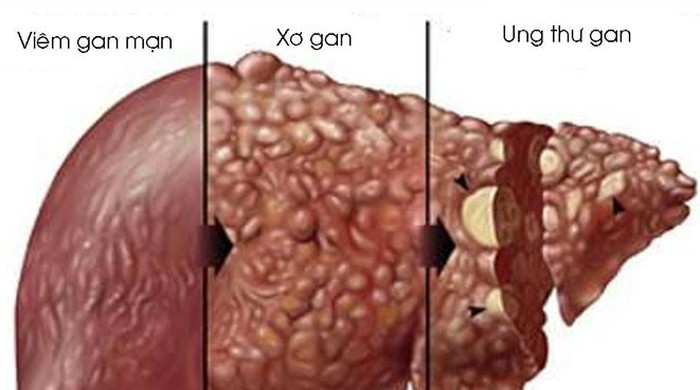 Lách to trong xơ gan - Hiểu rõ nguyên nhân, ảnh hưởng và cách điều trị hiệu quả