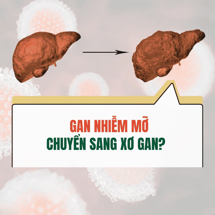 Dau Hieu Gan Nhiem Mo Chuyen Sang Xo Gan Can Luu Y Ngay 683143d4ce2a4