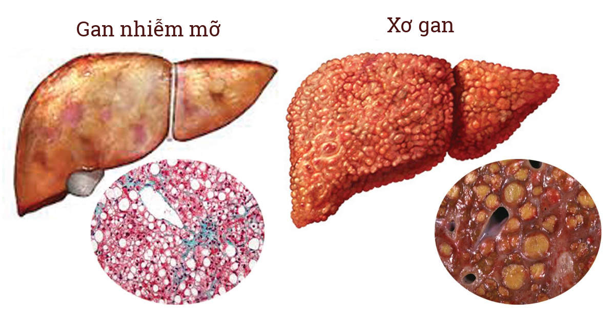Dấu hiệu gan nhiễm mỡ chuyển sang xơ gan cần lưu ý ngay