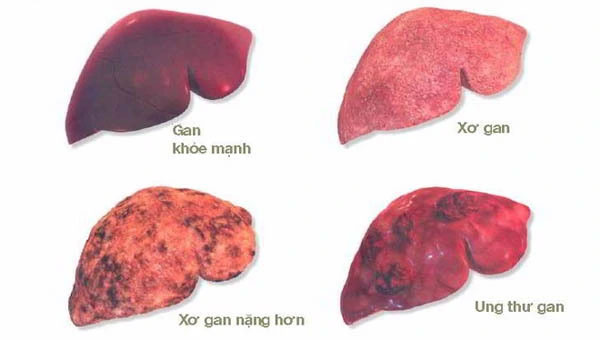 Dấu hiệu gan nhiễm mỡ chuyển sang xơ gan cần lưu ý ngay