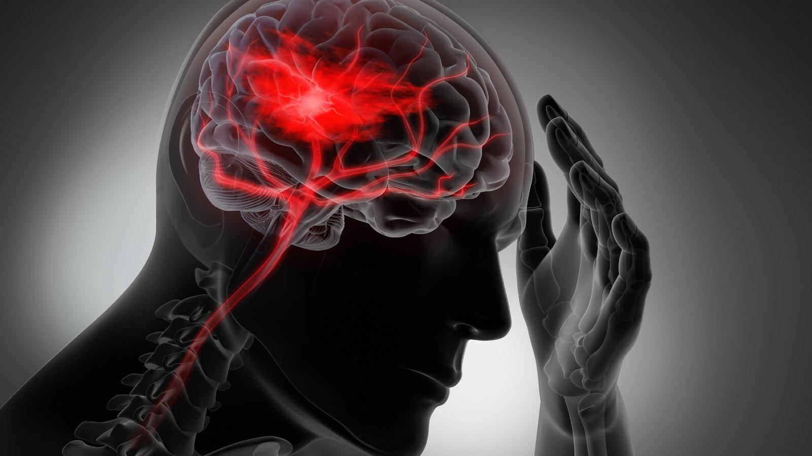 Đột quỵ do đâu?