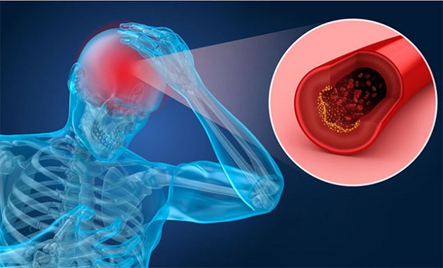 Đột Quỵ Não Là Gì? Nguyên Nhân  Triệu Chứng Cần Biết