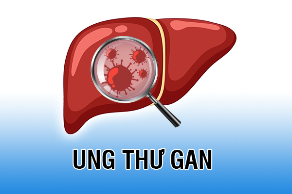 Nguyên nhân gây ung thư gan phổ biến và cách phòng tránh
