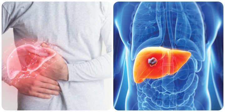 Phương pháp điều trị ung thư gan hiệu quả hiện nay