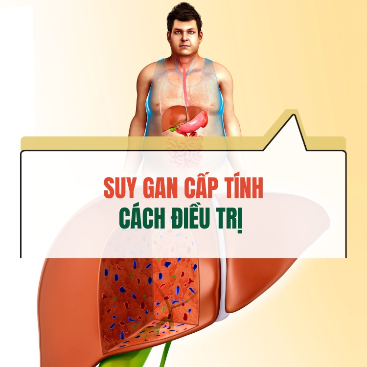 Suy Gan Cap Tinh Dieu Tri The Nao De Dat Hieu Qua Tot Nhat 68313d53cd515.webp
