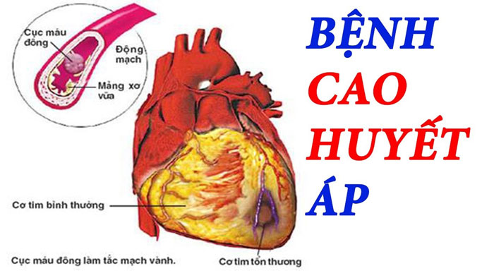 Thiếu máu não cục bộ: Triệu chứng và cách điều trị hiệu quả