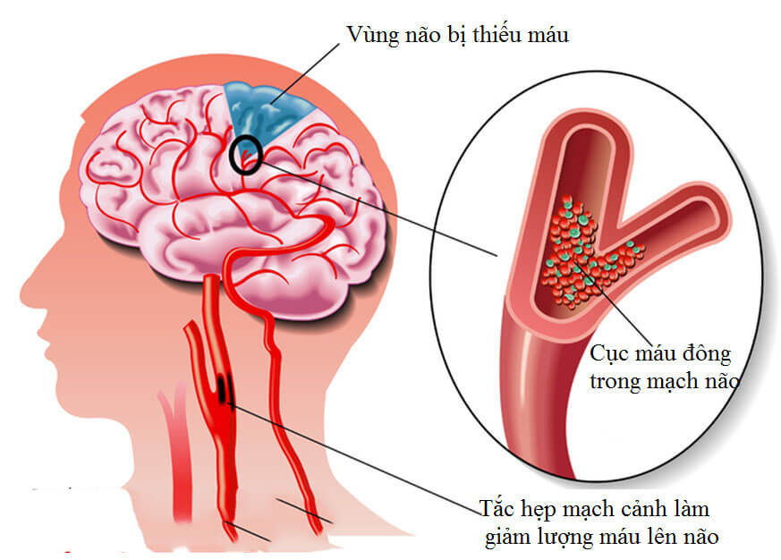 Thiếu máu não cục bộ: Triệu chứng và cách điều trị hiệu quả