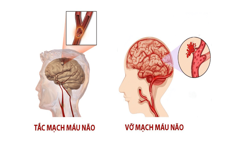 Đột Quỵ Và Tai Biến 1