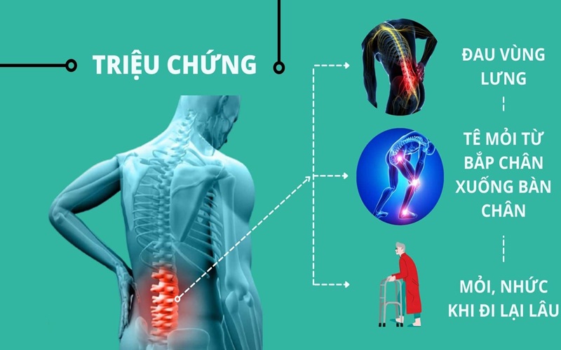 Triệu Chứng Của Thoát Vị đĩa đệm Chèn Dây Thần Kinh
