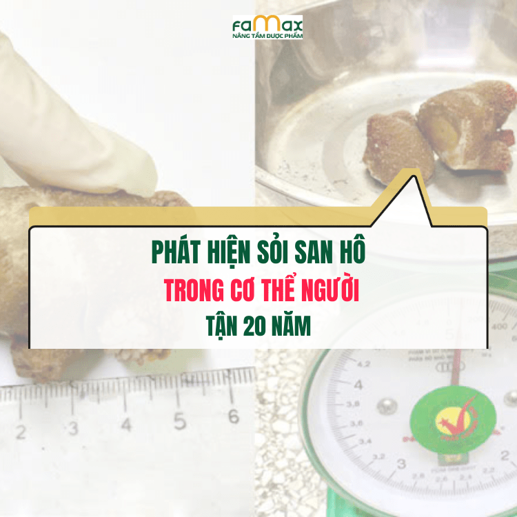 Cảnh Báo Cho Người Bệnh Sỏi Thận 2