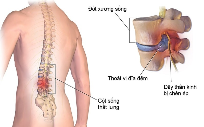 Người Thoát Vị đĩa đệm Chèn Dây Thần 1