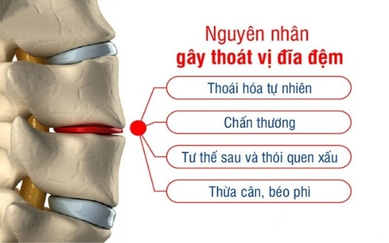 Nguyên Nhân Thoát Vị đĩa đệm