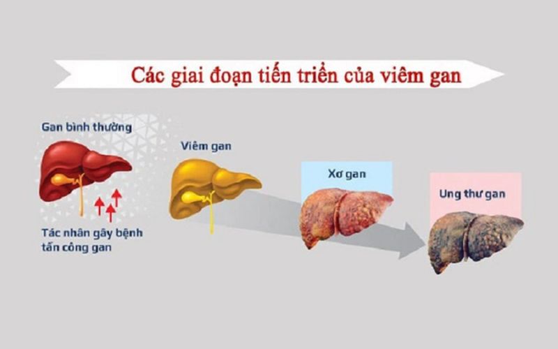 Cac Giai Doan Ung Thu Gan