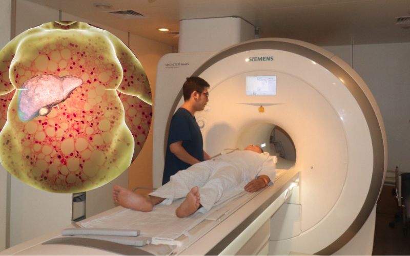 Chup Mri Phat Hien Ung Thu Gan