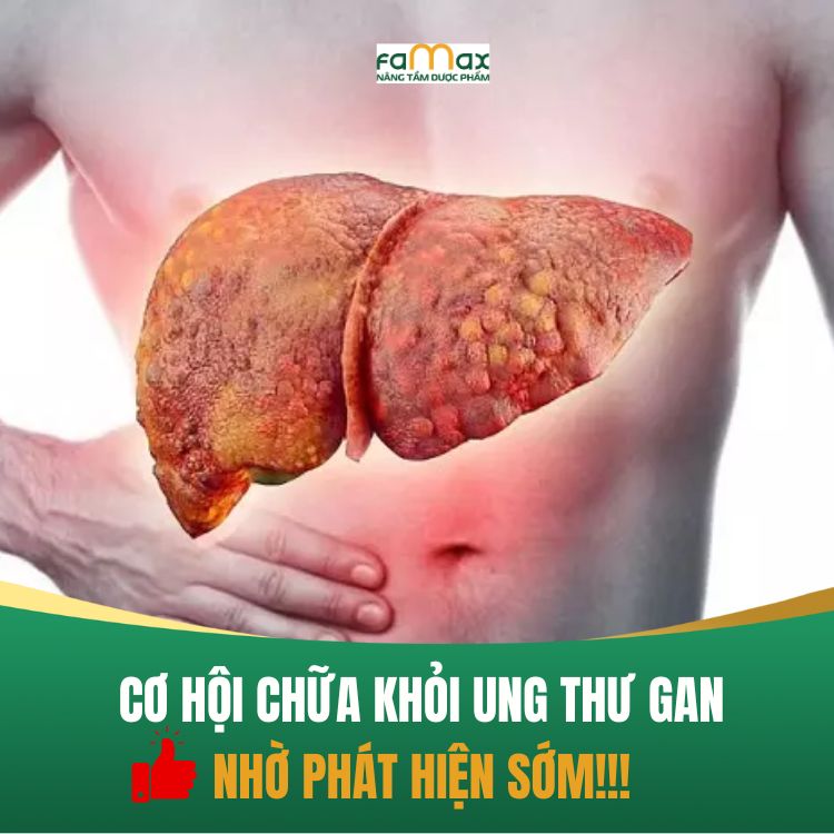 Co Hoi Chua Khoi Ung Thu Gan