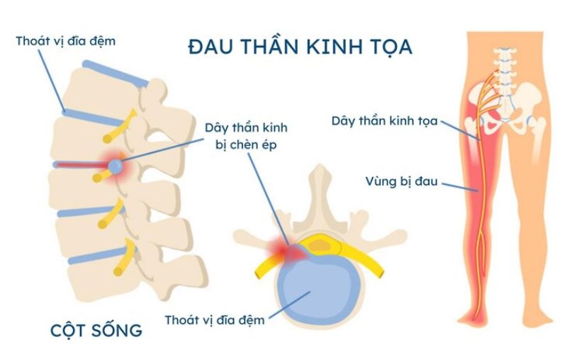 Dau Than Kinh Toa Gay Dau Lung Khi Nam
