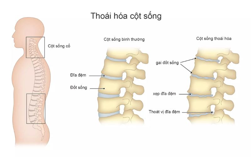 Thoai Hoa Cot Song Gay Dau Lung Khi Nam