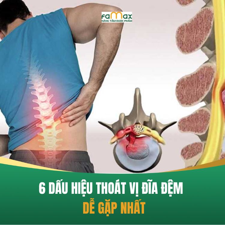 5 Dau Hieu Thoat Vi Dia Dem Va Cach Phong Ngua Hieu Qua 68ca317386eaa.webp
