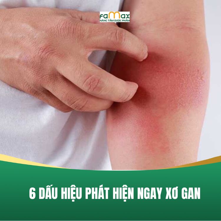Benh Xo Gan Nguy Hiem Va 6 Dau Hieu Nhan Biet De Nhat 68bfac0d67267.webp