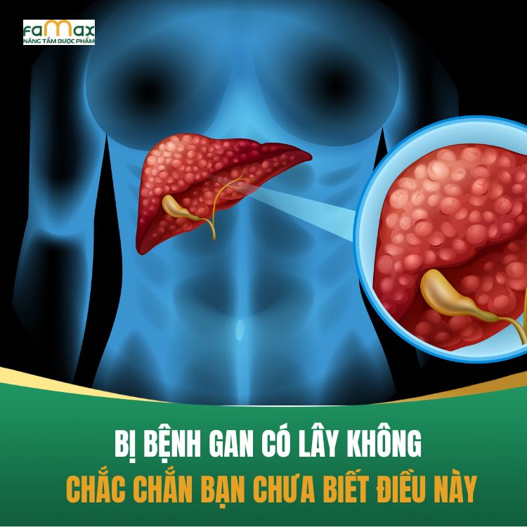 Bi Benh Gan Co Lay Khong 68d26596c8983.webp