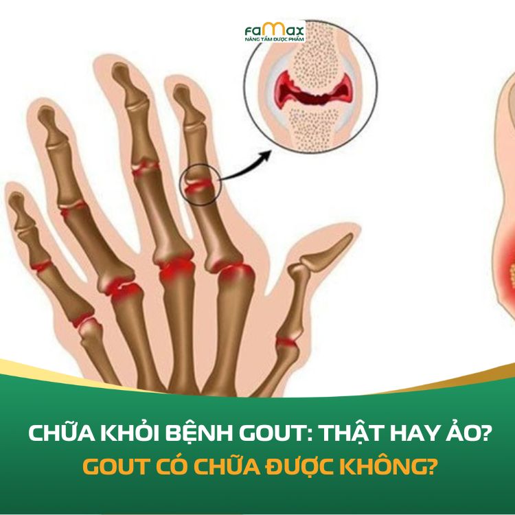 Gout Co Chua Duoc Khong 691d99ce4c5e4.webp