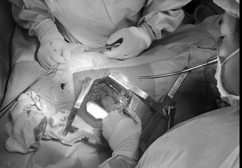 Phau Thuat Mo Long Nguc