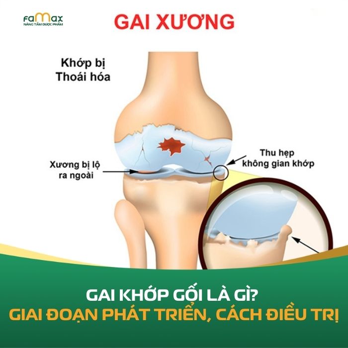 Gai Khop Dau Goi La Gi 6968461129c75.webp